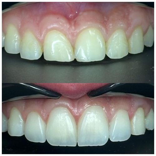 Veneer & Whitening