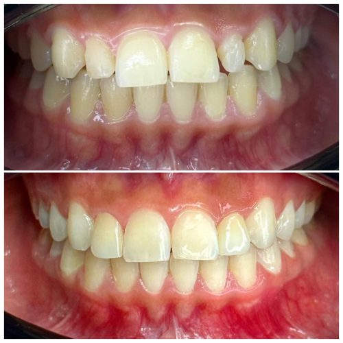 Veneer & Whitening